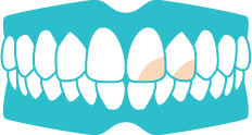 部分的な歯の変色が気になる