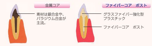 ファイバーコア ポスト