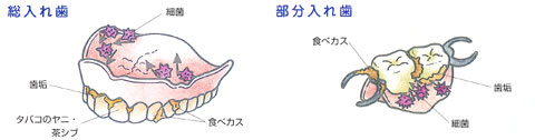 いつも入れ歯を清潔に保ちましょう