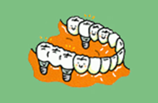 健康な歯をまったく削ることなく歯のない部分にインプラントを入れます