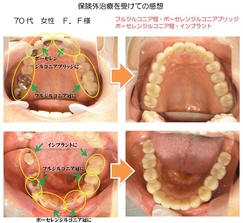 フルジルコニア・ポーセレンジルコニア・インプラント症例写真
